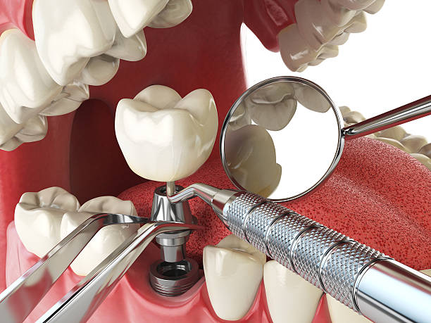Best Emergency Tooth Extraction in Galesburg, IL